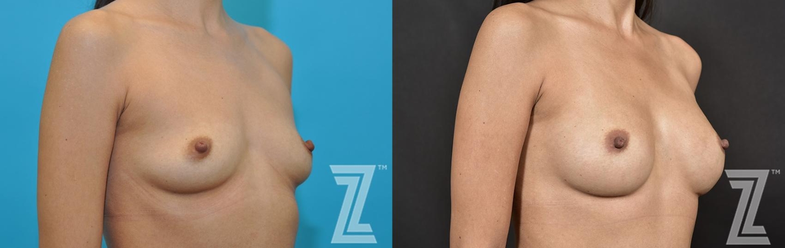 Austin Oblique View Before & After Breast Augmentation of 32-Year-Old Female Patient With Silicone Implants with Cohesive Silicone Gel - The Piazza Center