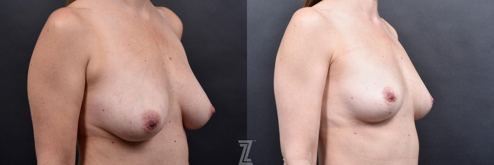 Austin Breast Reduction Before & After Gallery - Patient 606521 - Image 4 - The Piazza Center