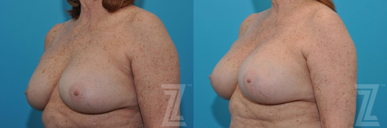 Austin Breast Augmentation Revision Before & After Gallery - Patient 132886549 - Image 2 - The Piazza Center