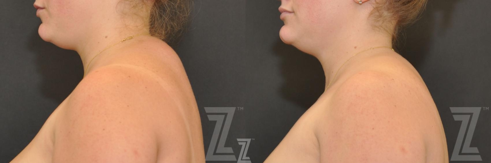 Austin CoolSculpting® Before & After Gallery - Patient 132905387 - Image 1 - The Piazza Center