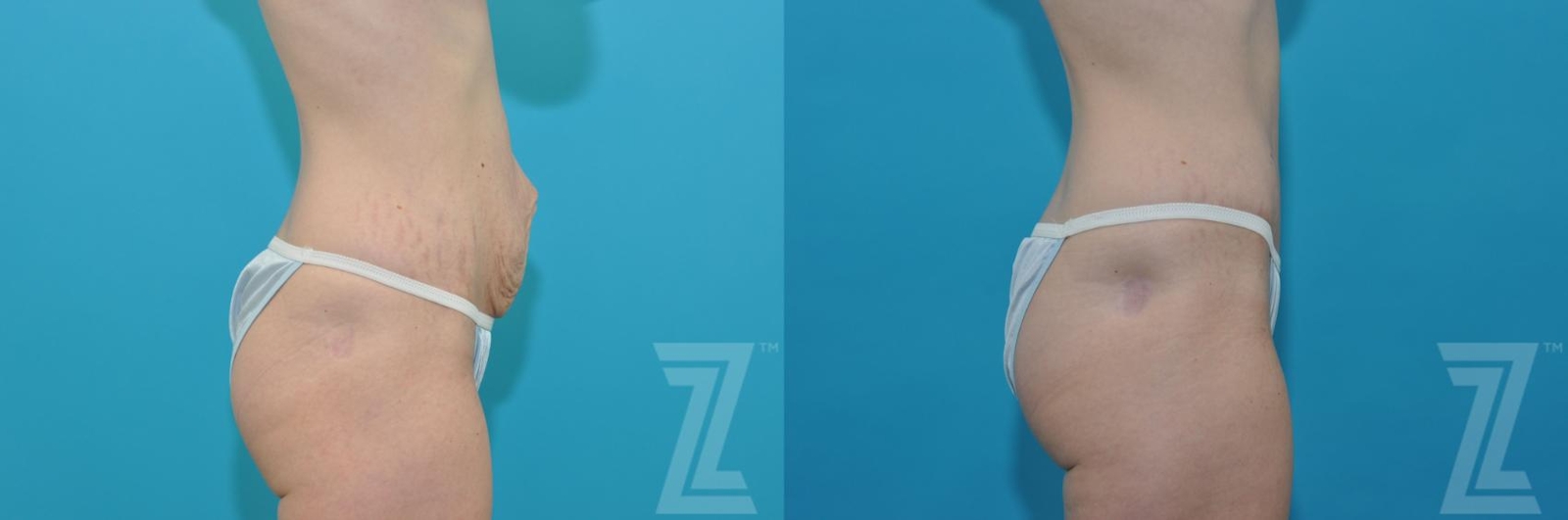 Austin Tummy Tuck Before & After Gallery - Patient 132886867 - Image 4 - The Piazza Center