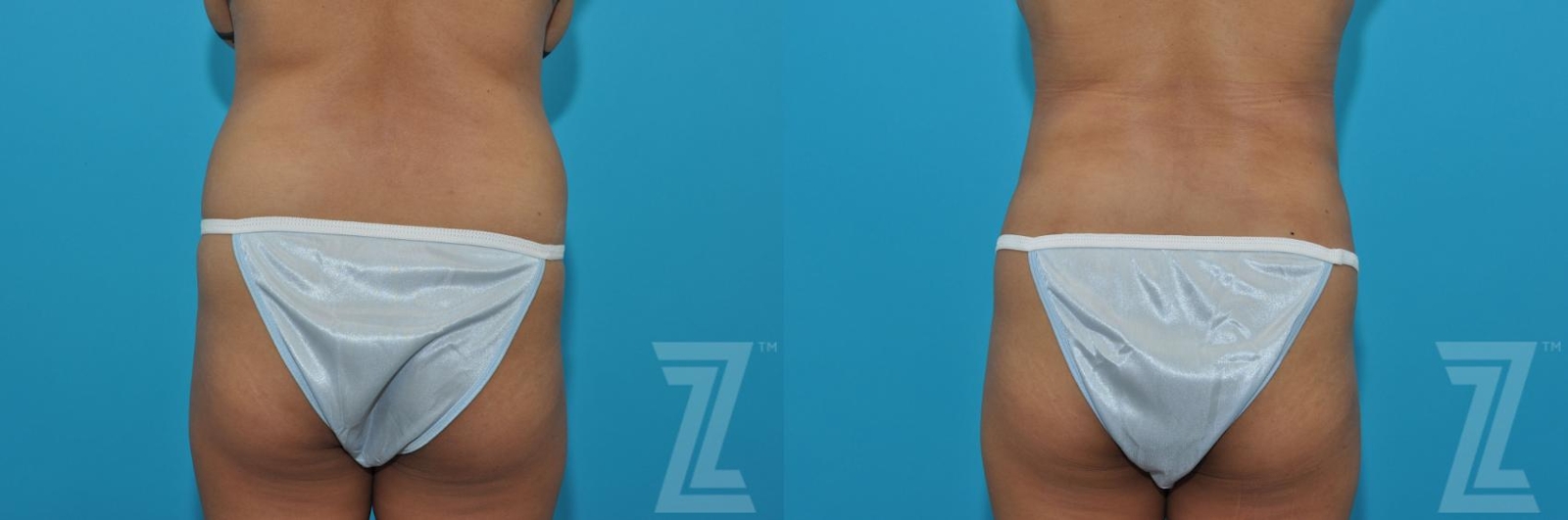 Austin Liposuction Before & After Gallery - Patient 132903277 - Image 1 - The Piazza Center