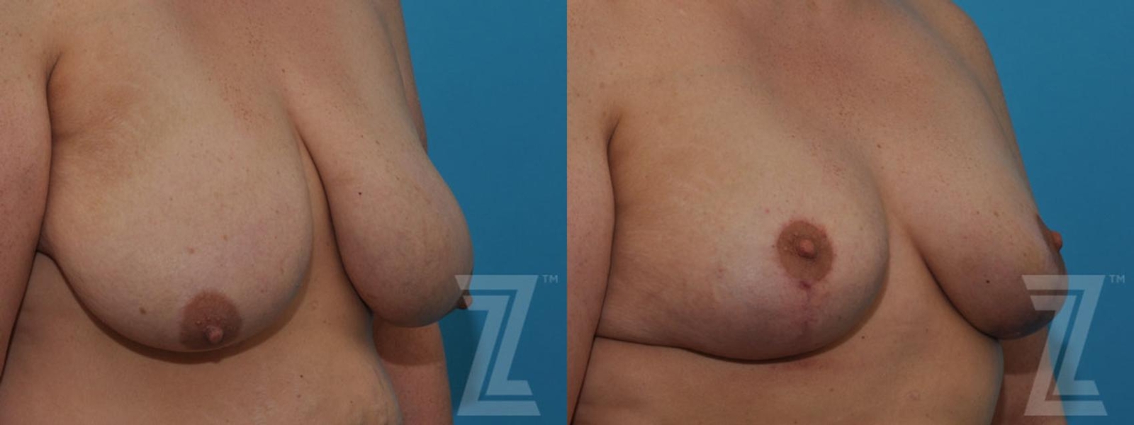 Austin Breast Reduction Before & After Gallery - Patient 132886599 - Image 4 - The Piazza Center