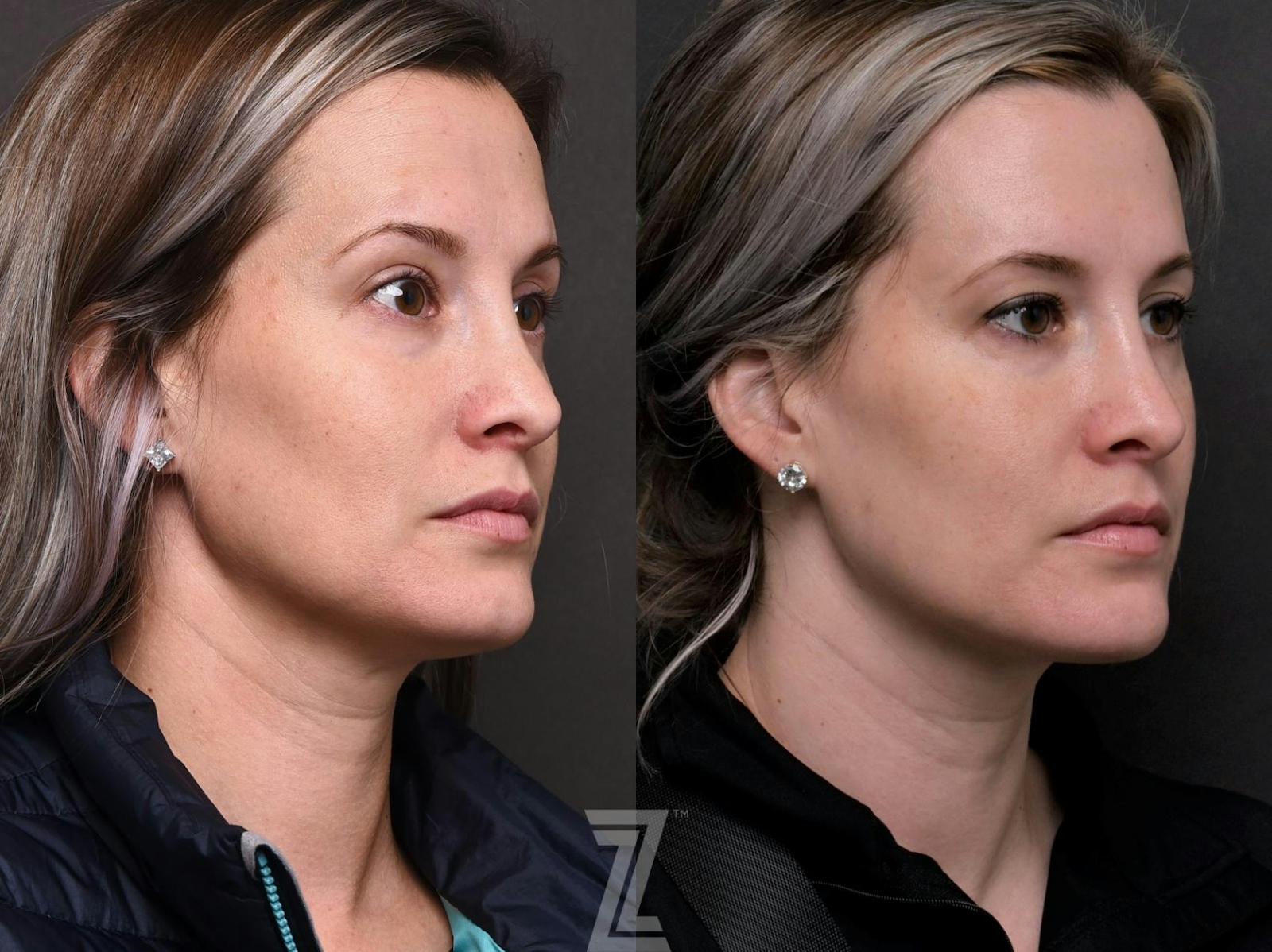 Austin Injectable Fillers Before & After Gallery - Patient 132963122 - Image 2 - The Piazza Center