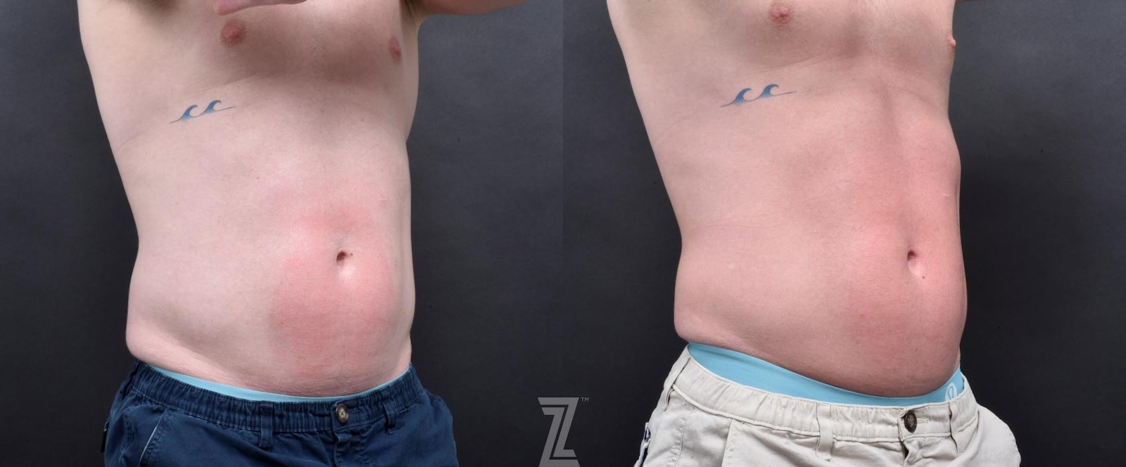 Austin Emsulpt Neo® Before & After Gallery - Patient 132905398 - Image 3 - The Piazza Center