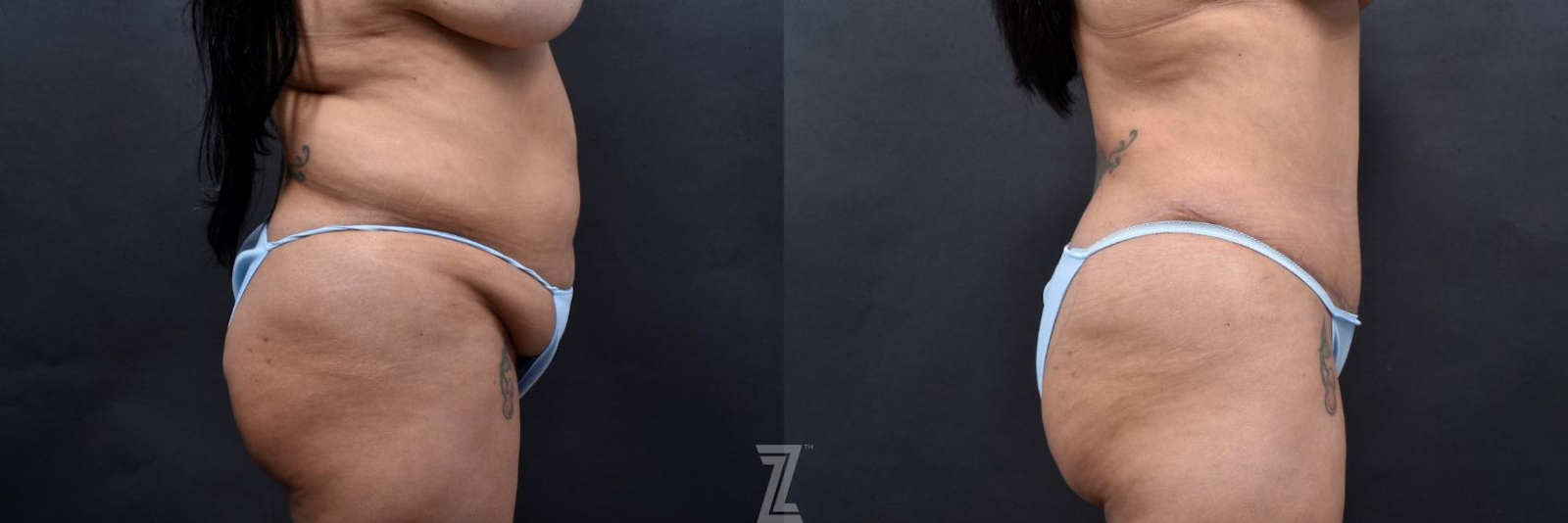 Austin 6 Month Post-OP Mommy Makeover in Austin, TX by Dr. Rocco Piazza - Lateral Abdomen View - The Piazza Center