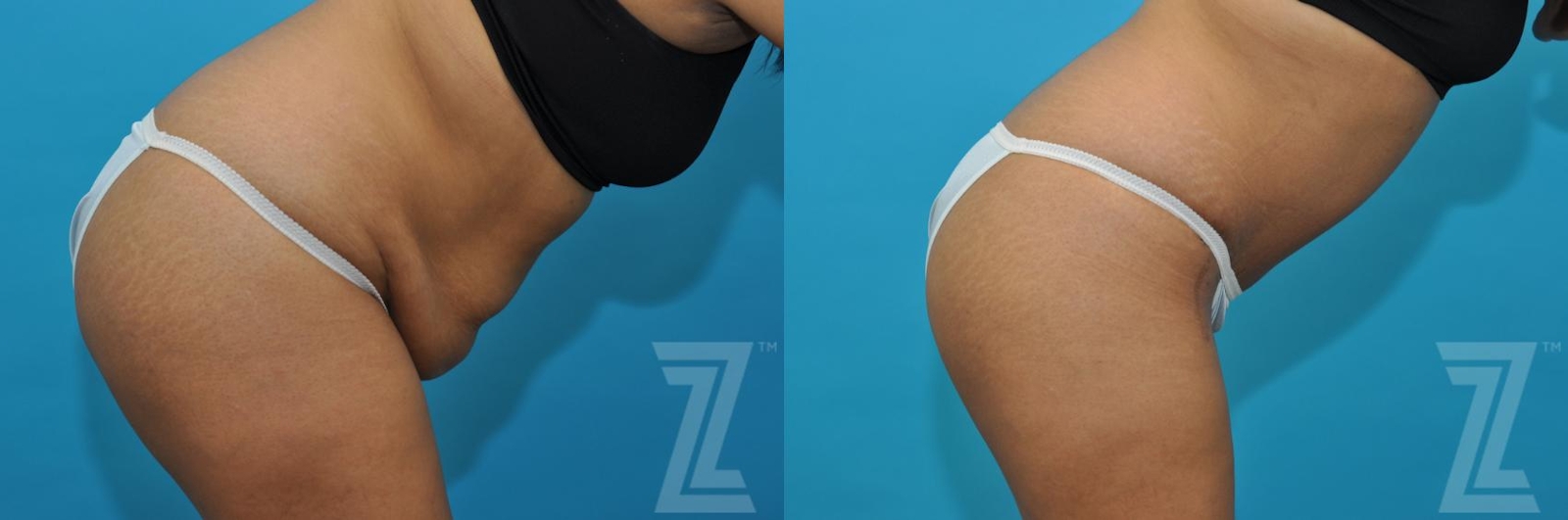Austin Tummy Tuck Before & After Gallery - Patient 132886811 - Image 5 - The Piazza Center