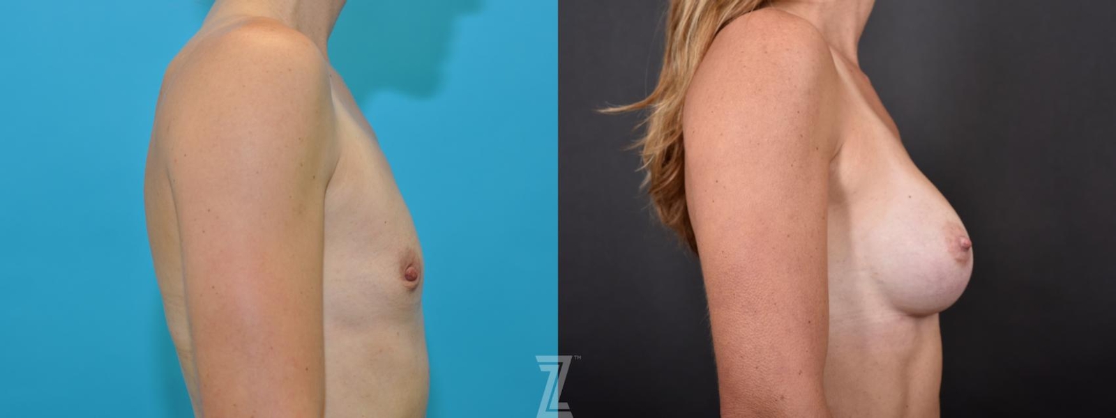 Austin Lateral View of Before and After 5 year post op of Silicone Implants with Highly Cohesive Gel (Gummy Bear Implants) - The Piazza Center