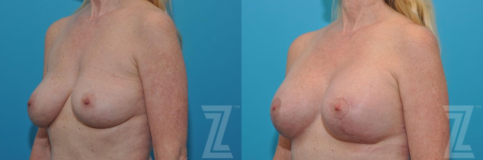 Austin Breast Augmentation Revision Before & After Gallery - Patient 132794909 - Image 2 - The Piazza Center