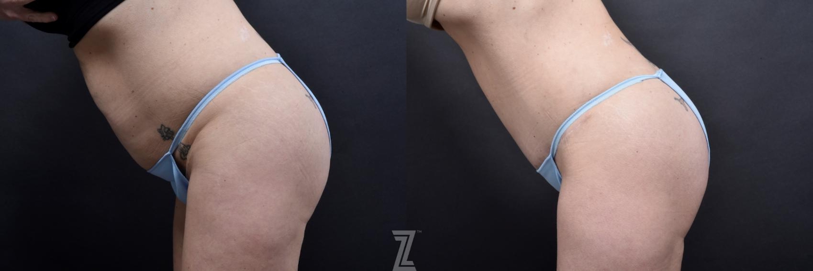 Austin Tummy Tuck Before & After Gallery - Patient 132886820 - Image 3 - The Piazza Center