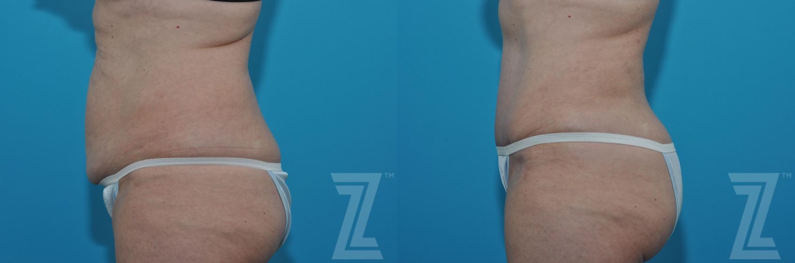 Austin Tummy Tuck Before & After Gallery - Patient 132886903 - Image 2 - The Piazza Center