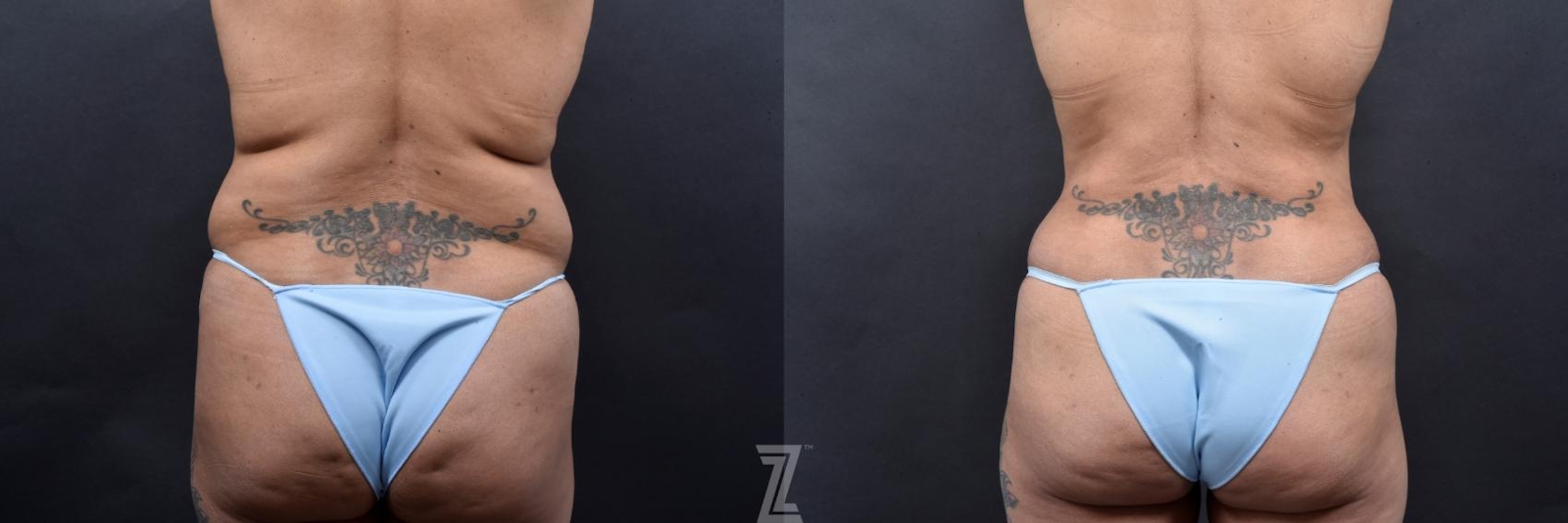 Austin 52-Year-Old Mommy Makeover Before & After by Dr. Rocco Piazza in Austin, Texas - Posterior View - The Piazza Center