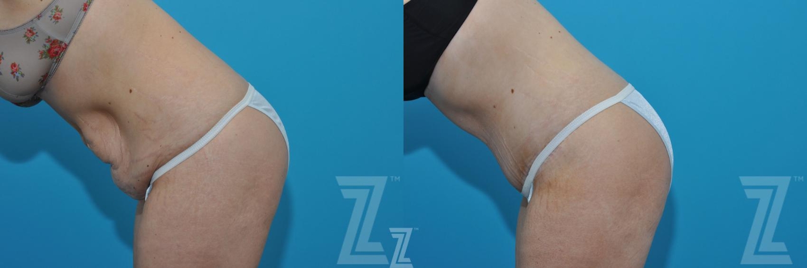 Austin Tummy Tuck Before & After Gallery - Patient 620256 - Image 3 - The Piazza Center