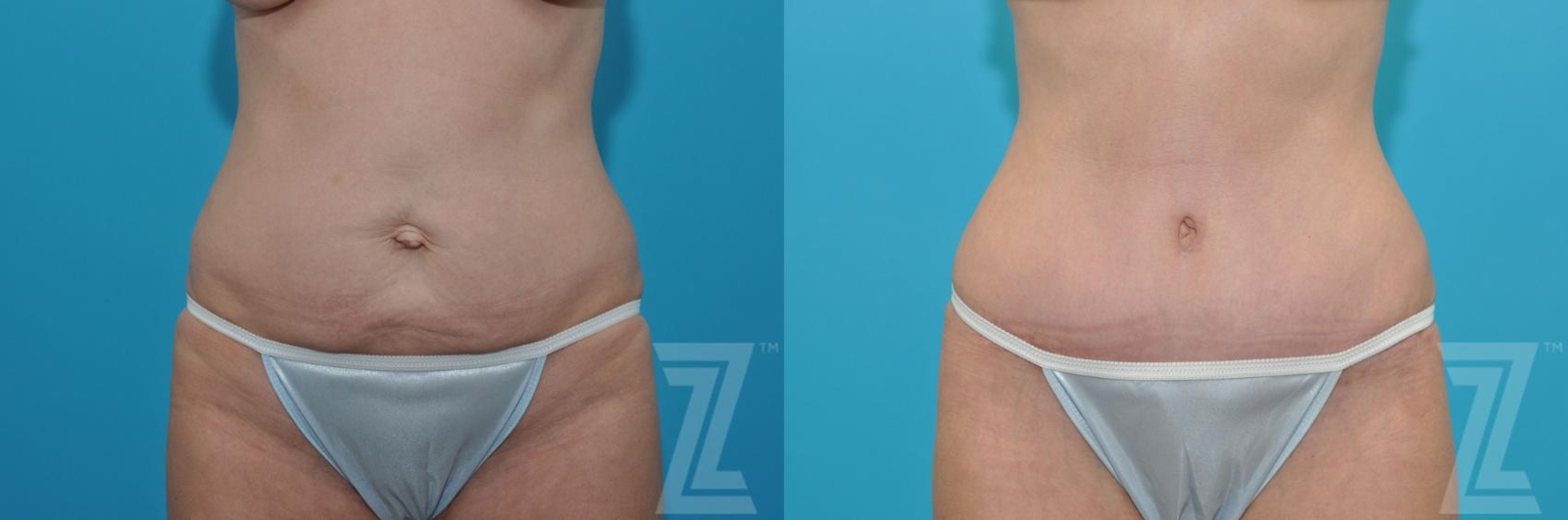 Austin Tummy Tuck Before & After Gallery - Patient 132886905 - Image 1 - The Piazza Center