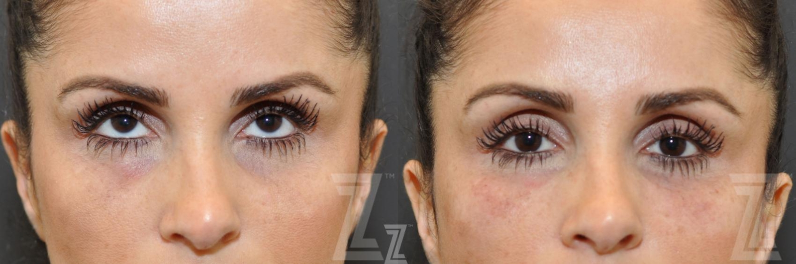 Austin Injectable Fillers Before & After Gallery - Patient 132963099 - Image 1 - The Piazza Center