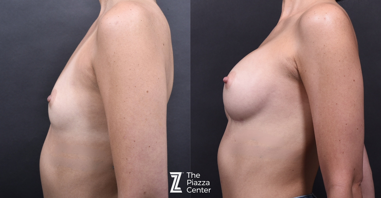 Austin Breast Augmentation Before & After Gallery - Patient 790705 - Image 5 - The Piazza Center