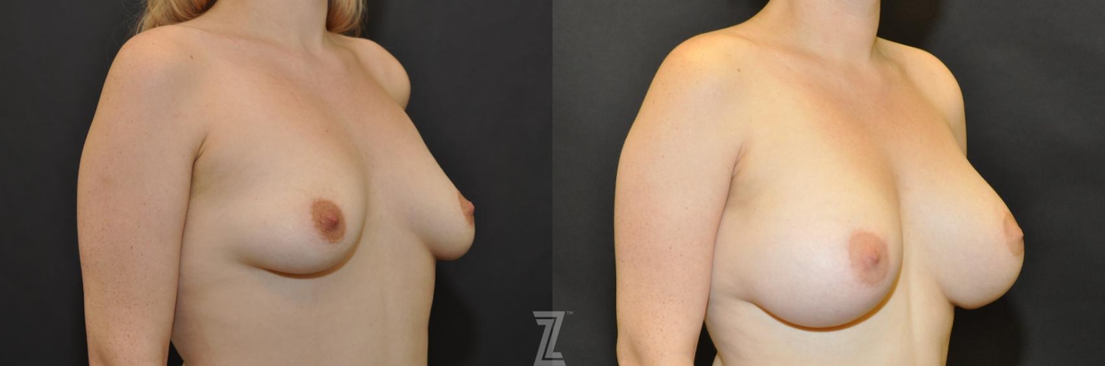 Austin Oblique view before & after images of 28 year old woman 2 year post op with Silicone Implants with Cohesive Silicone Gel - The Piazza Center - The Piazza Center