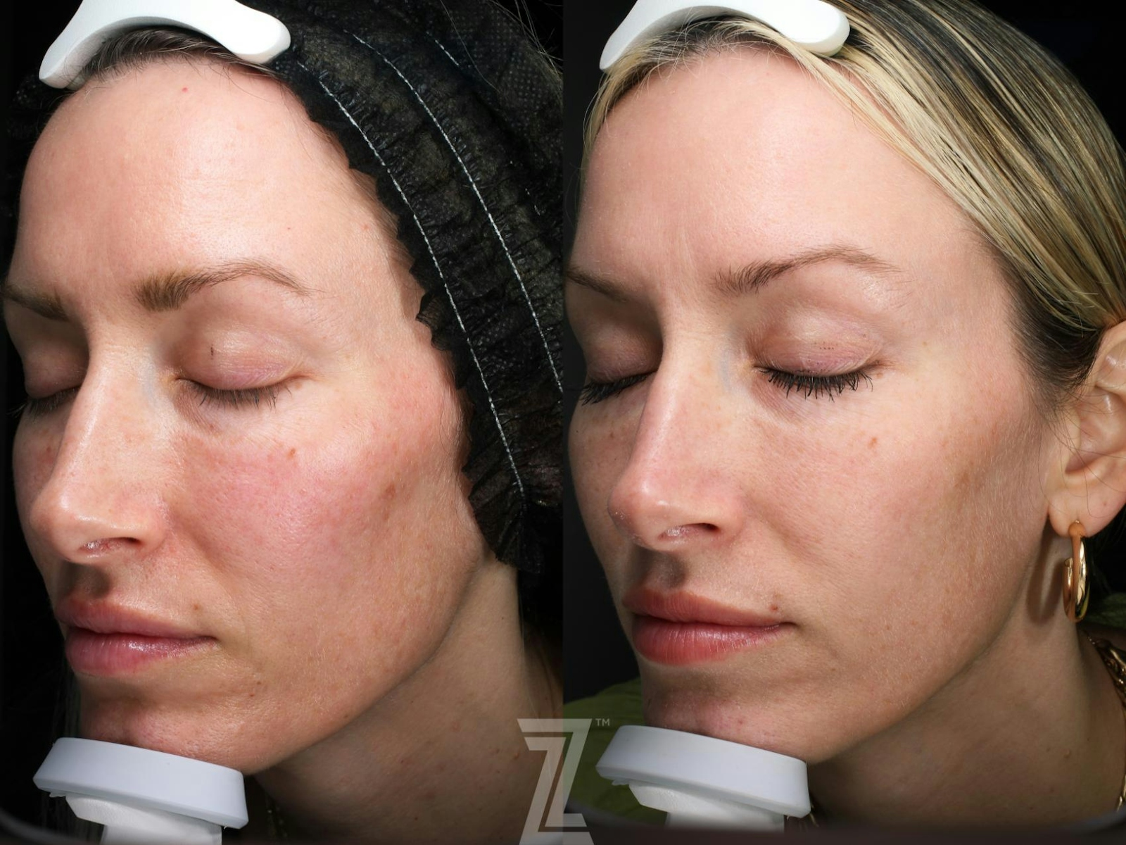 Austin SkinPen Microneedling Before & After Gallery - Patient 115122 - Image 1 - The Piazza Center