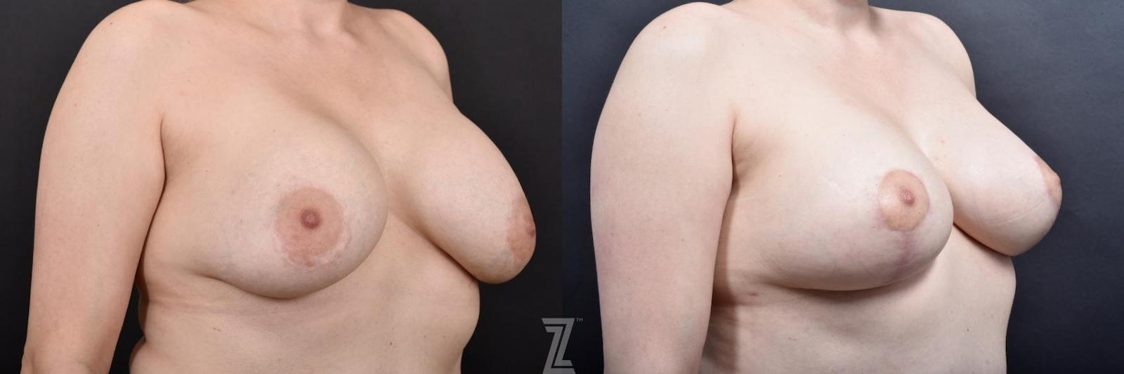 Austin Breast Augmentation Revision Before & After Gallery - Patient 132886548 - Image 4 - The Piazza Center