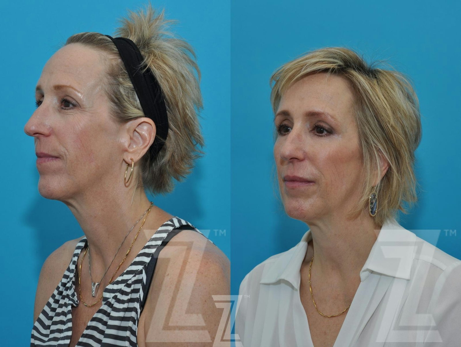 Austin Injectable Fillers Before & After Gallery - Patient 132963096 - Image 3 - The Piazza Center