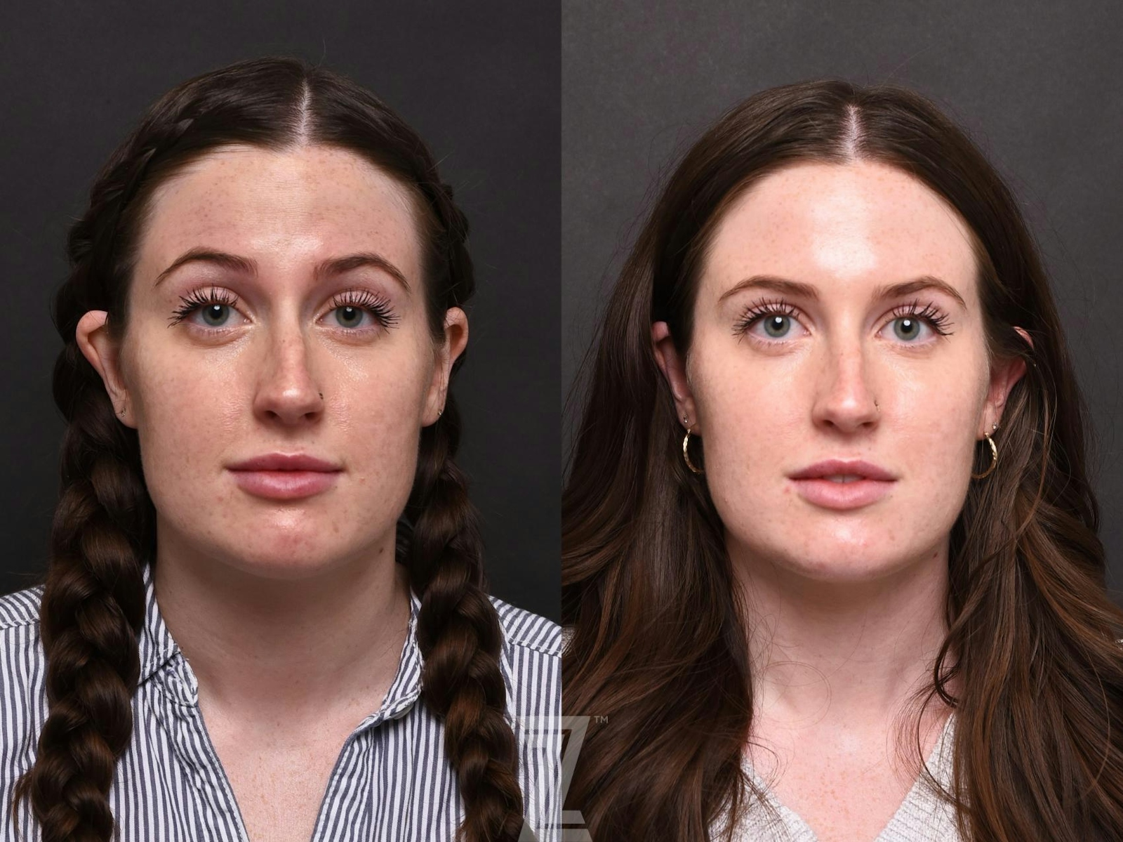 Austin Wrinkle Relaxers Before & After Gallery - Patient 132906322 - Image 3 - The Piazza Center