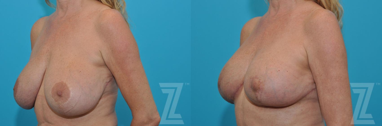 Austin Breast Augmentation Revision Before & After Gallery - Patient 132886579 - Image 2 - The Piazza Center