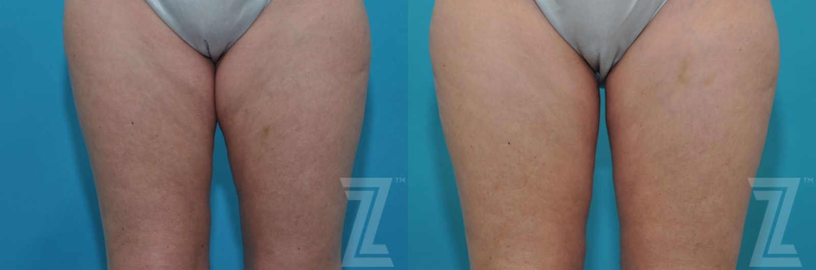 Austin Tummy Tuck Before & After Gallery - Patient 132886874 - Image 7 - The Piazza Center