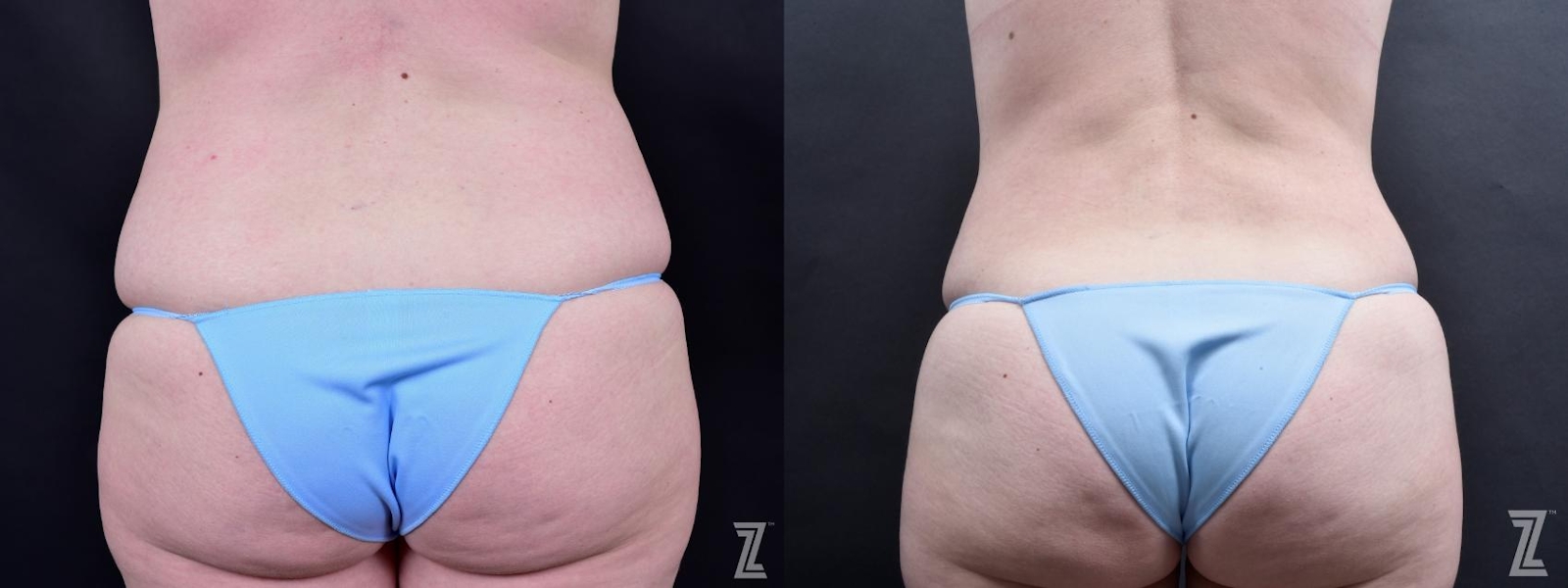 Austin Tummy Tuck Before & After Gallery - Patient 132886803 - Image 6 - The Piazza Center