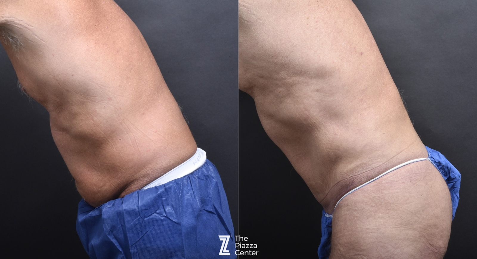 Austin Skin Pinch Before & After Gallery - Patient 283397 - Image 3 - The Piazza Center