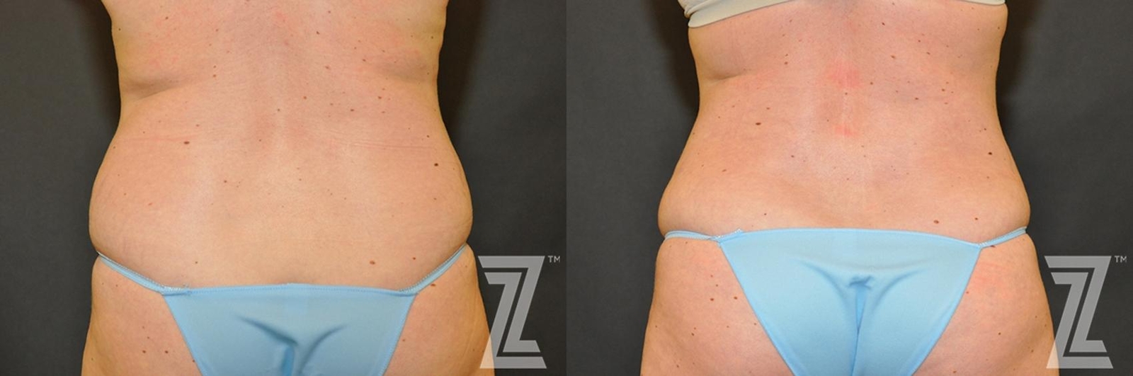 Austin Tummy Tuck Before & After Gallery - Patient 132886883 - Image 6 - The Piazza Center