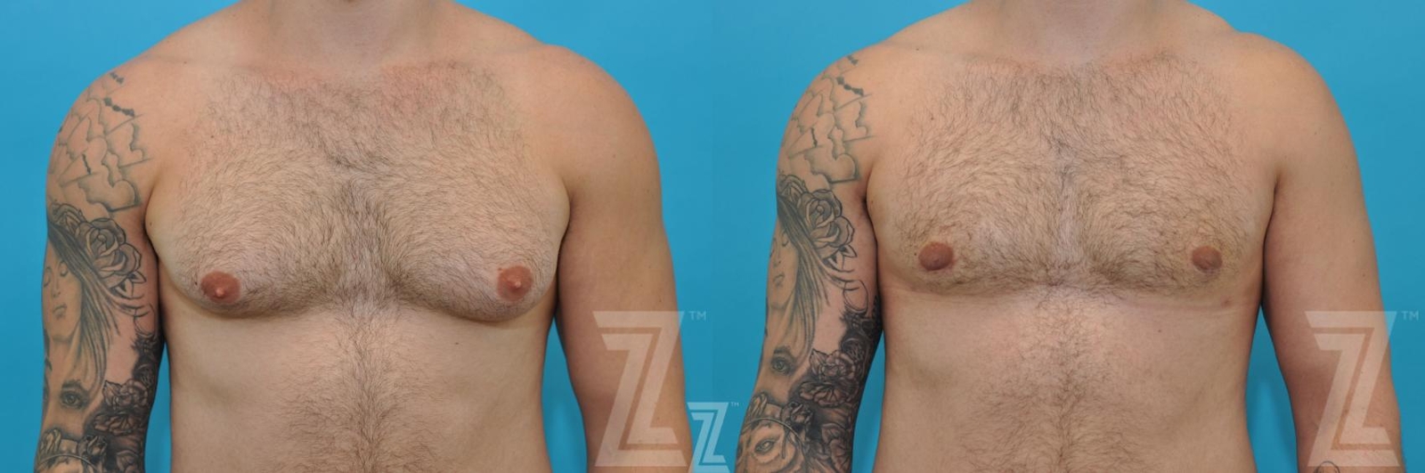 Austin Gynecomastia/Male Breast Reduction Before & After Gallery - Patient 118963 - Image 1 - The Piazza Center