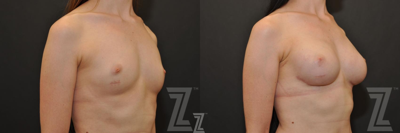 Austin Breast Reconstruction Before & After Gallery - Patient 132886774 - Image 4 - The Piazza Center