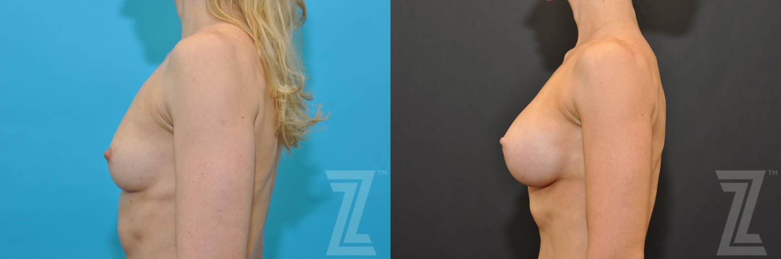 Austin Lateral View before and after of 36 year old woman with Silicone Implants with Highly Cohesive Gel (Gummy Bear Implants) - The Piazza Center - The Piazza Center