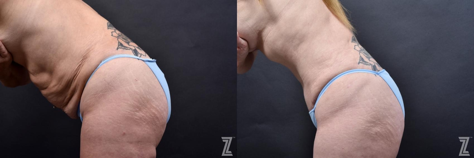 Austin Tummy Tuck Before & After Gallery - Patient 132886812 - Image 3 - The Piazza Center