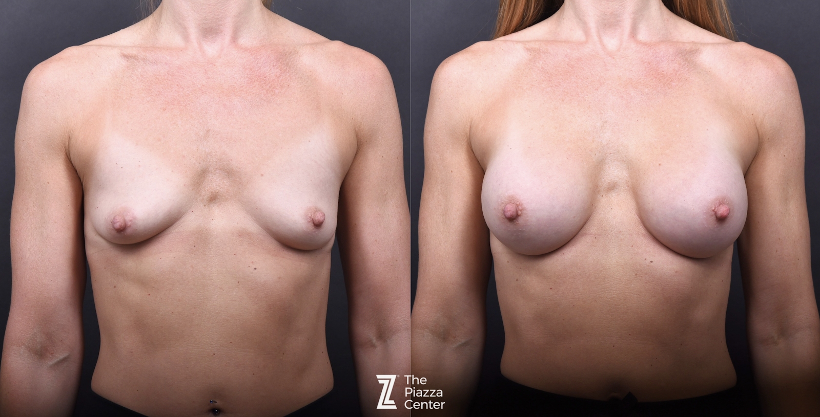 Austin Breast Augmentation Before & After Gallery - Patient 428919 - Image 1 - The Piazza Center