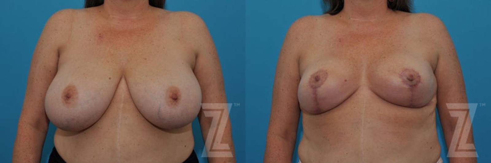 Austin Breast Reduction Before & After Gallery - Patient 132886747 - Image 2 - The Piazza Center