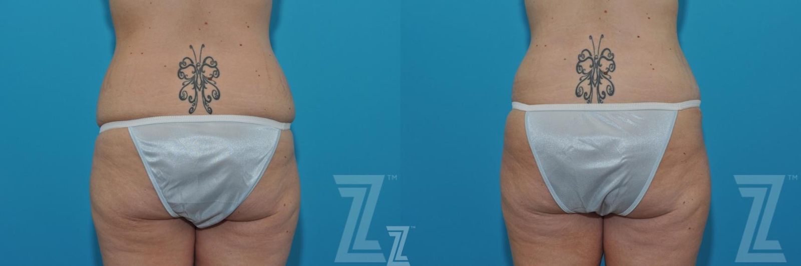 Austin Tummy Tuck Before & After Gallery - Patient 620256 - Image 6 - The Piazza Center