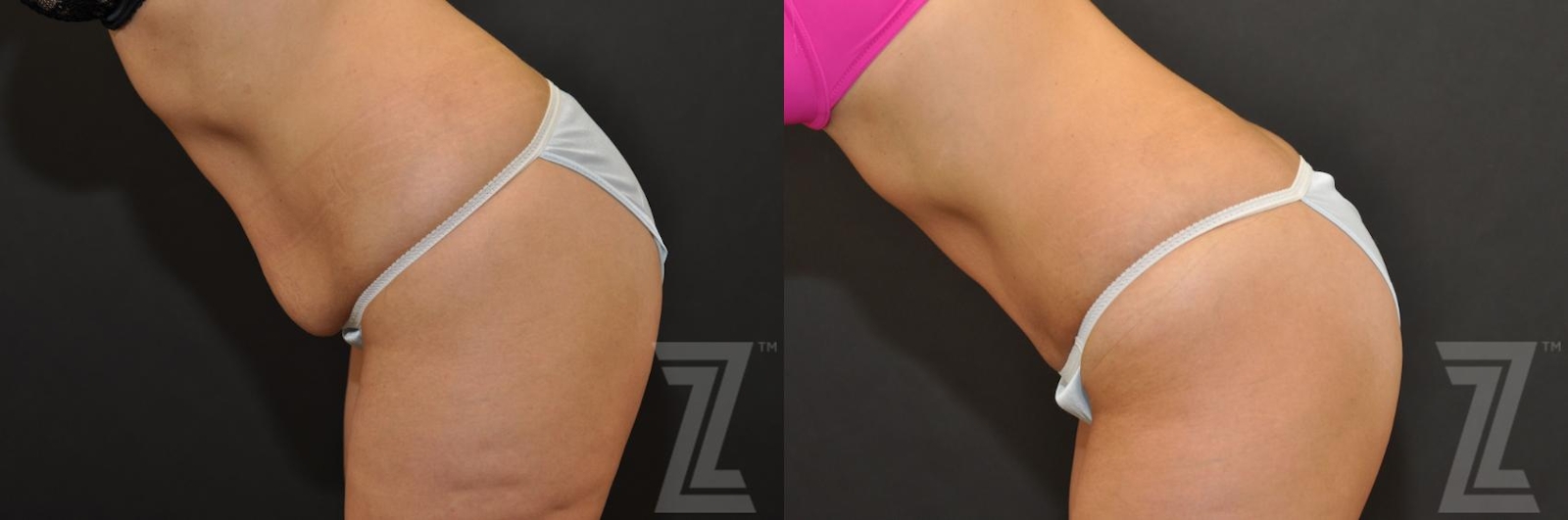 Austin Tummy Tuck Before & After Gallery - Patient 132886896 - Image 3 - The Piazza Center