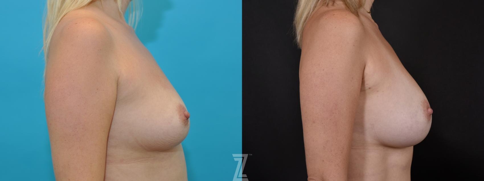Austin 5 year post op lateral view before & after images of 35 year old woman with Silicone Implants with Highly Cohesive Gel (Gummy Bear Implants) - The Piazza Center