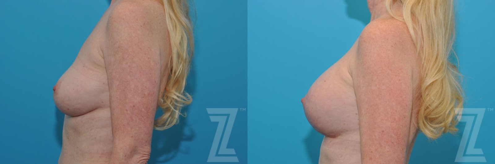 Austin Breast Augmentation Revision Before & After Gallery - Patient 132794909 - Image 3 - The Piazza Center