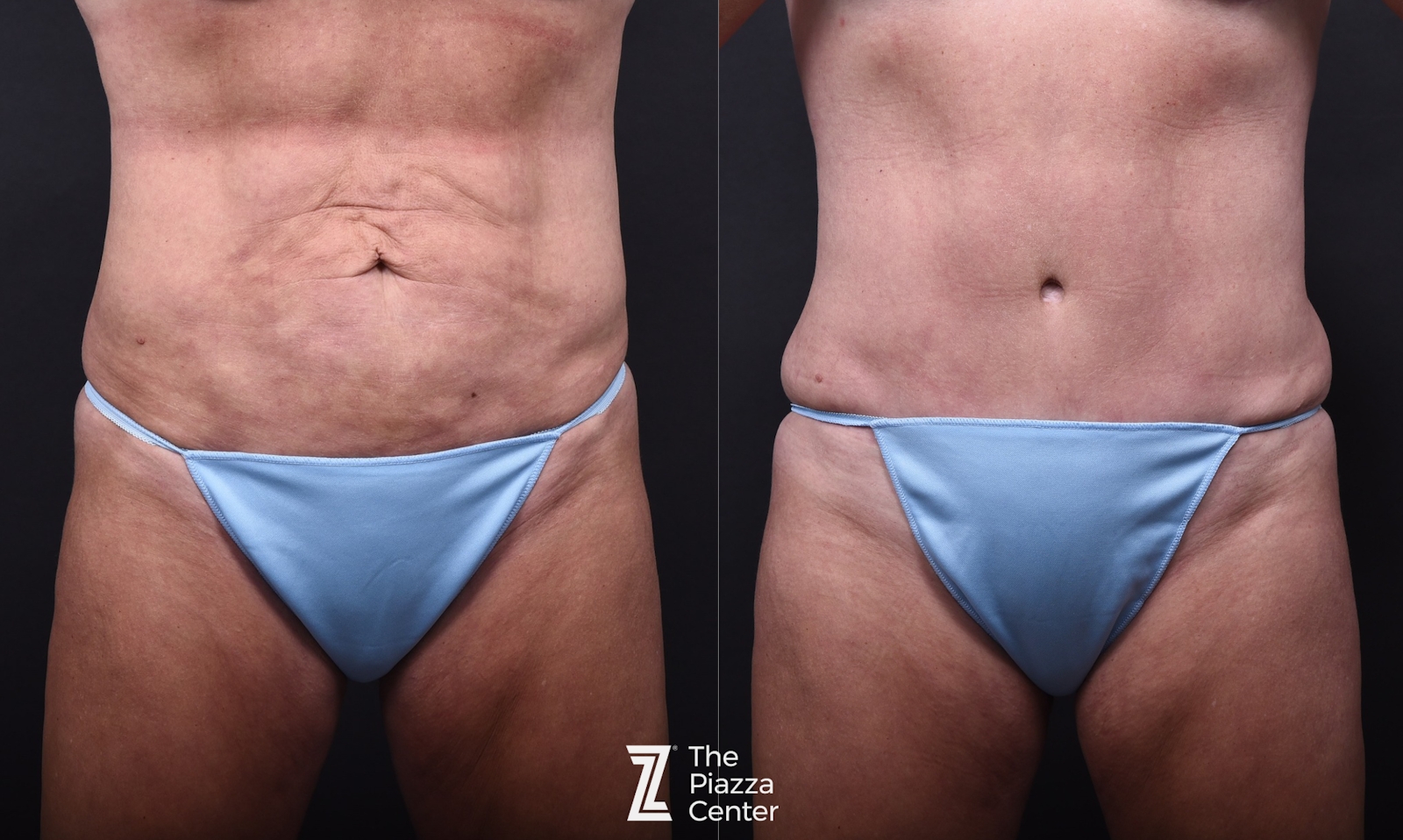 Austin Breast Augmentation Before & After Gallery - Patient 158035 - Image 7 - The Piazza Center