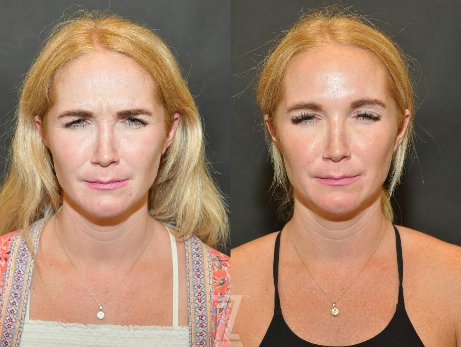Austin Wrinkle Relaxers Before & After Gallery - Patient 132906317 - Image 1 - The Piazza Center