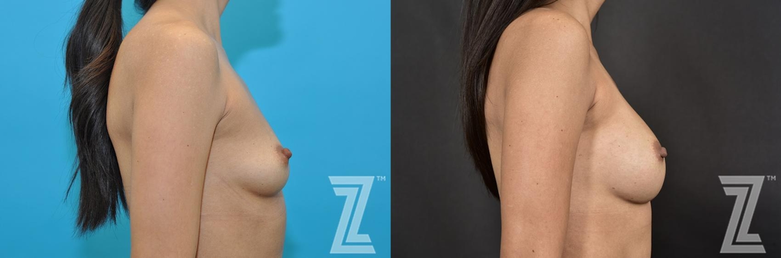 Austin Lateral View Before & After Breast Augmentation of 32-Year-Old Female Patient With Silicone Implants with Cohesive Silicone Gel - The Piazza Center