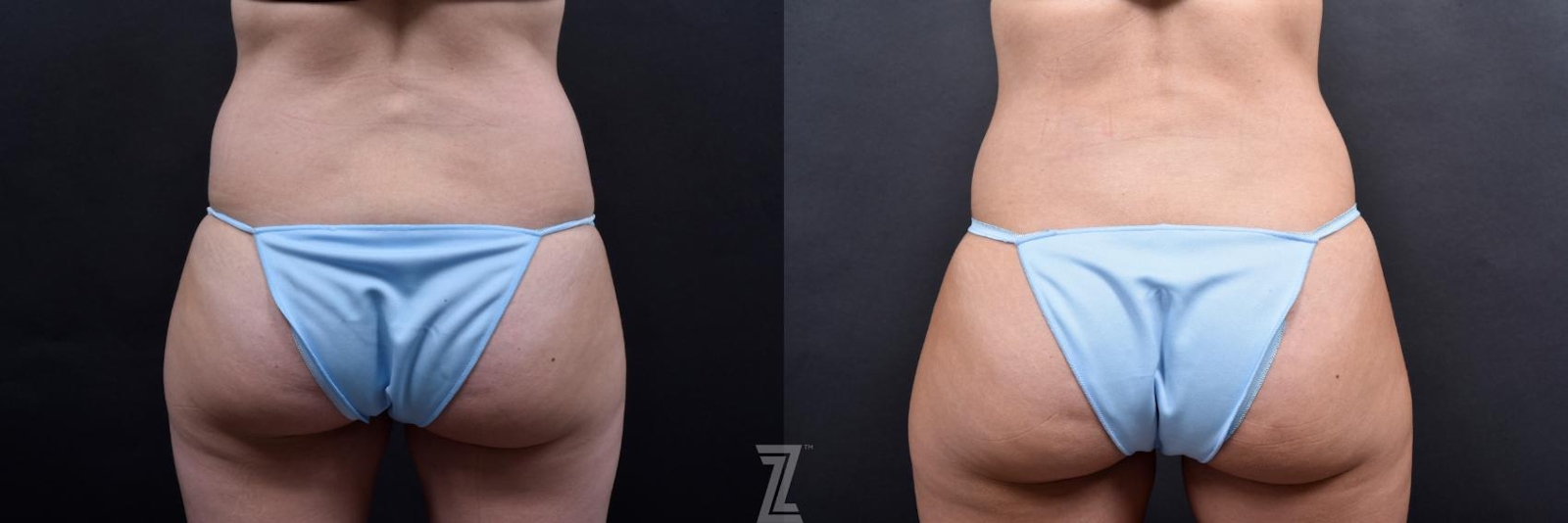 Austin Tummy Tuck Before & After Gallery - Patient 132886800 - Image 6 - The Piazza Center