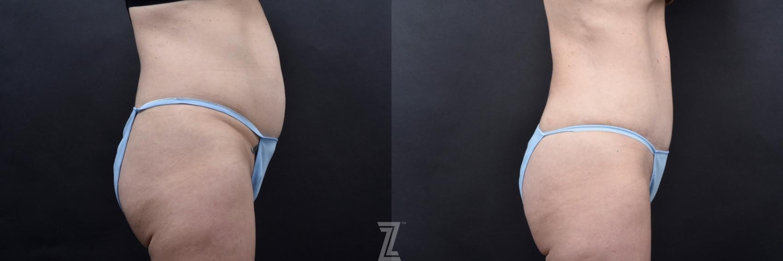 Austin Tummy Tuck Before & After Gallery - Patient 132886820 - Image 4 - The Piazza Center