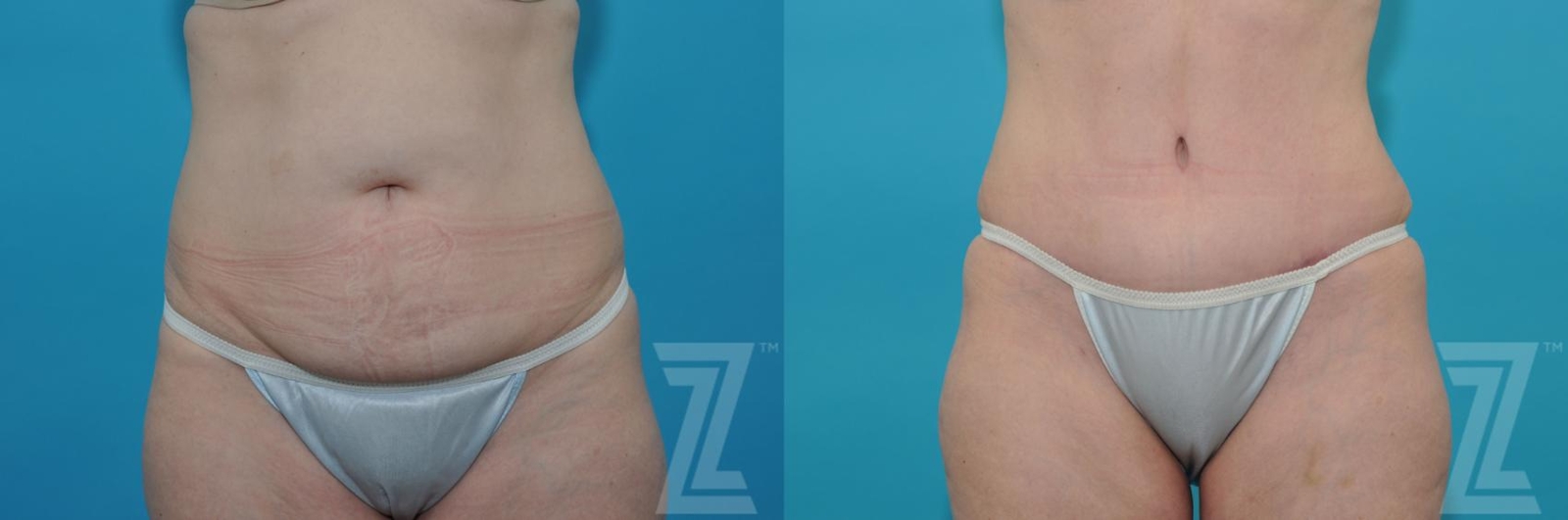 Austin Tummy Tuck Before & After Gallery - Patient 132886874 - Image 1 - The Piazza Center