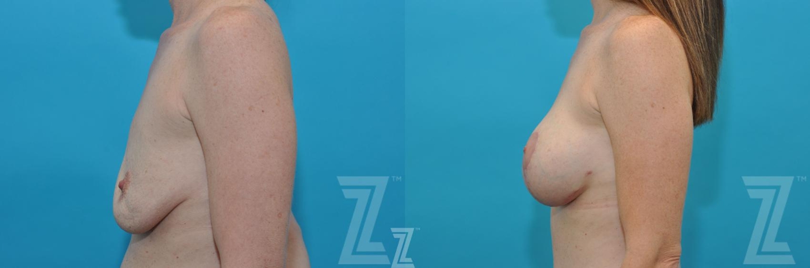 Austin Side Breast view before & after images of 35 year old woman mommy make over - Dr. Rocco Piazza Austin TX - The Piazza Center
