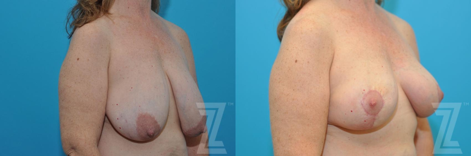 Austin Breast Reduction Before & After Gallery - Patient 132886744 - Image 4 - The Piazza Center