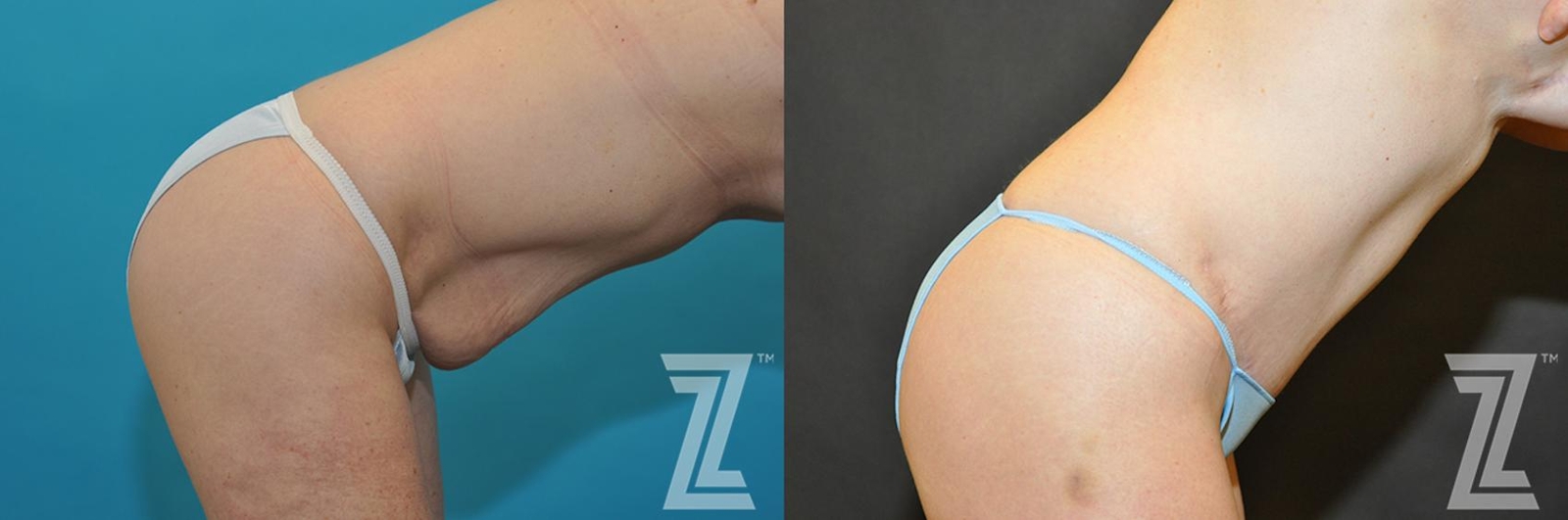 Austin Tummy Tuck Before & After Gallery - Patient 132886891 - Image 5 - The Piazza Center