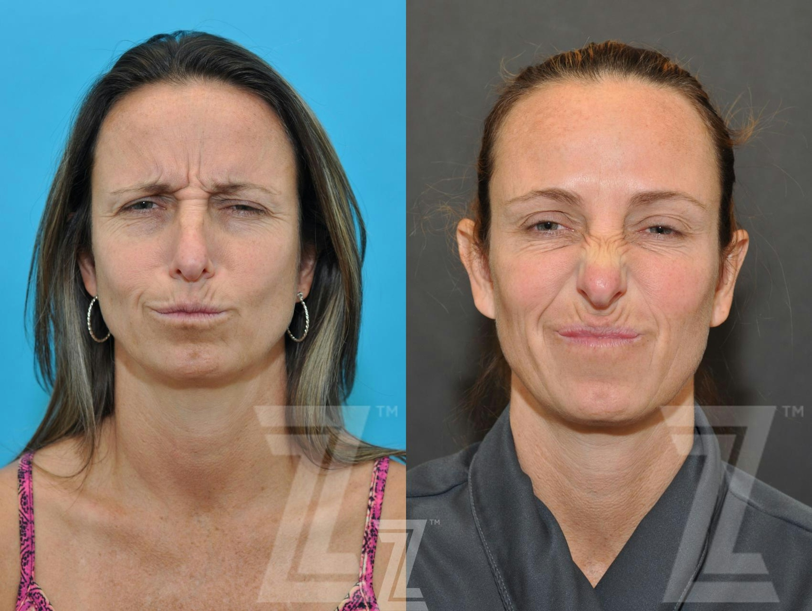 Austin Wrinkle Relaxers Before & After Gallery - Patient 132906321 - Image 3 - The Piazza Center